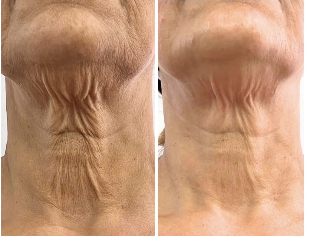 copy of beige white minimalist beauty skincare before after collage instagram post