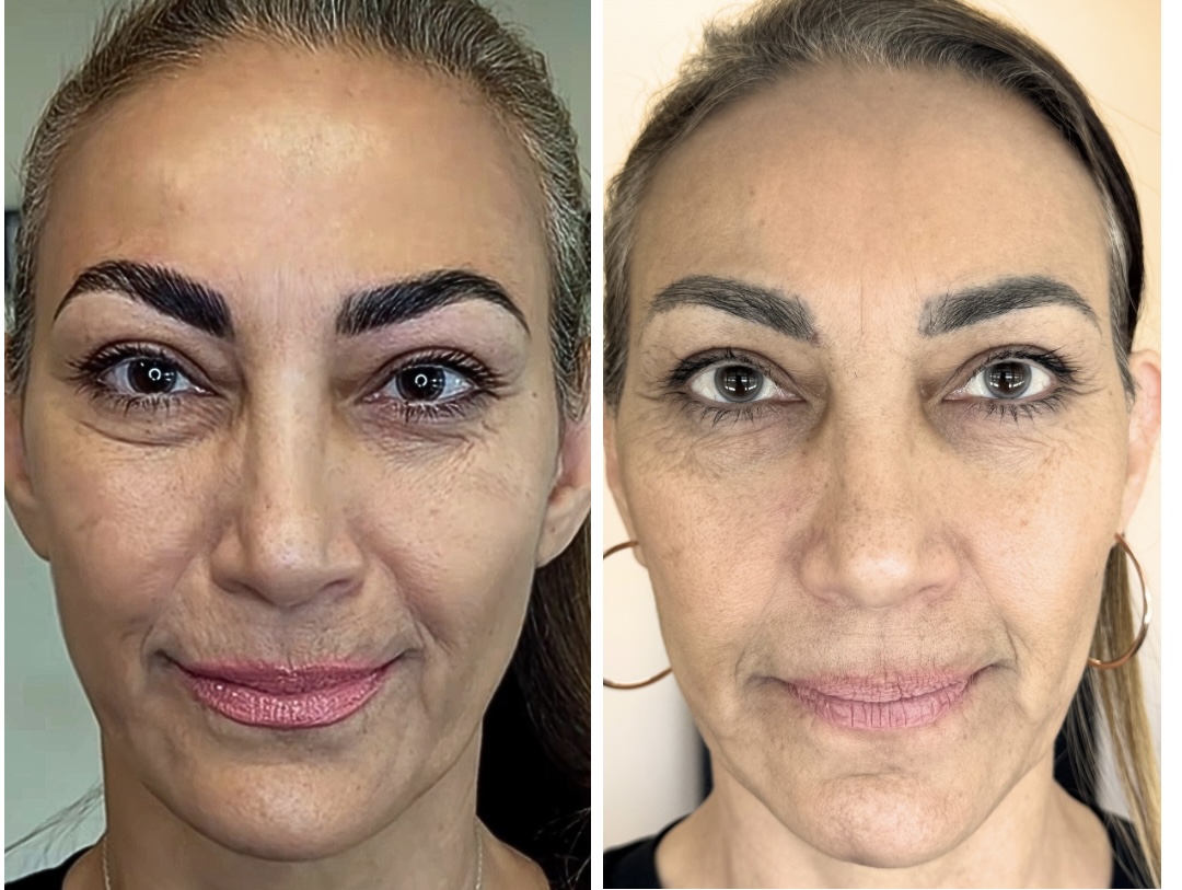 copy of beige white minimalist beauty skincare before after collage instagram post 2